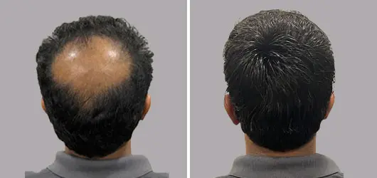 Services Hair Replacement System