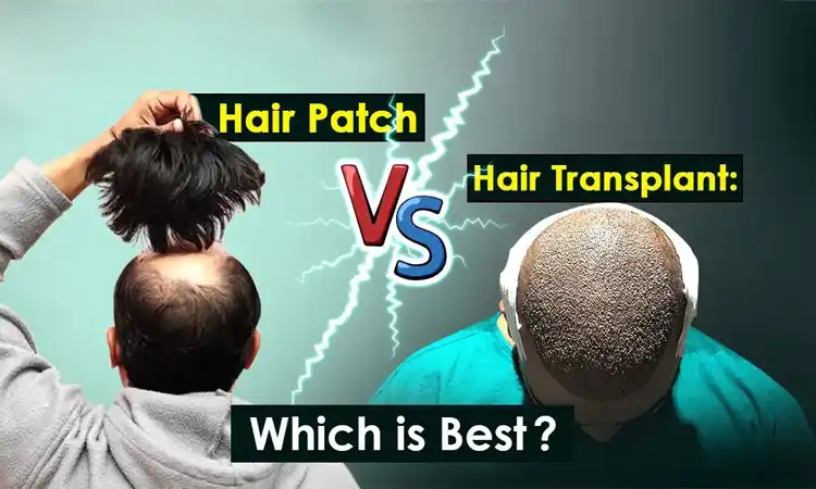 Complete Info Hair Transplant vs Hair Patch Which Is Better