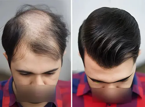 What Is Hair Filling for Men