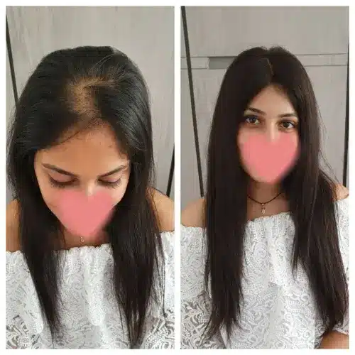What Is Non-Surgical Hair Replacement Services for women