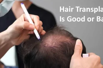 Know Hair Transplant Is Good or Bad