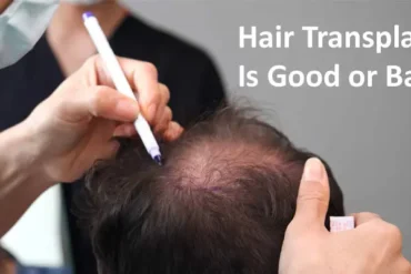 Know Hair Transplant Is Good or Bad