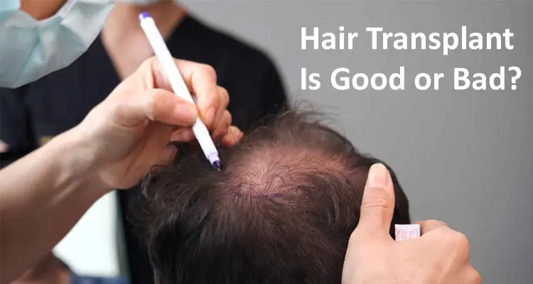 Know Hair Transplant Is Good or Bad