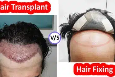 Know Hair Transplant or Hair Fixing Which Is Better