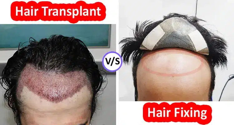 Know Hair Transplant or Hair Fixing Which Is Better