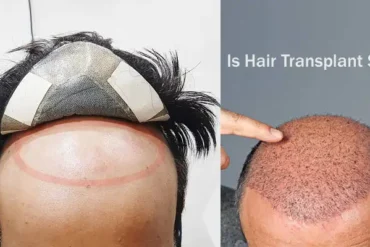 Know Is Hair Transplant Safe