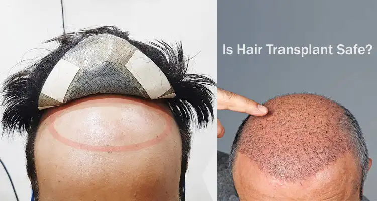 Know Is Hair Transplant Safe