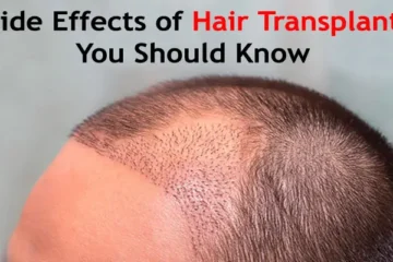 Side Effects of Hair Transplant You Should Know