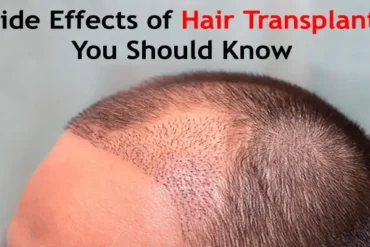 Side Effects of Hair Transplant You Should Know