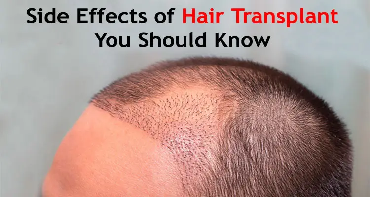 Side Effects of Hair Transplant You Should Know