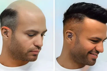 What Is the Cost of Hair Patch in Oman