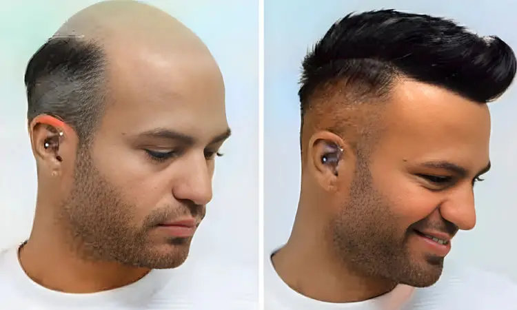 What Is the Cost of Hair Patch in Oman