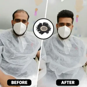 What Is Hair System service by Smart Hair Fixing